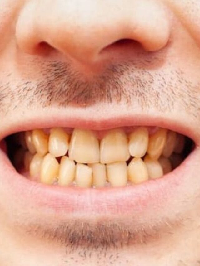 pile daant ghar per saaf kaise kare