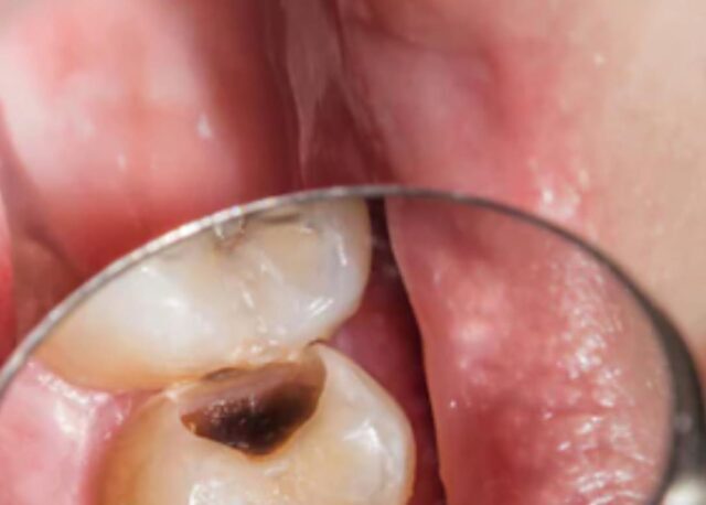 Tooth Cavity