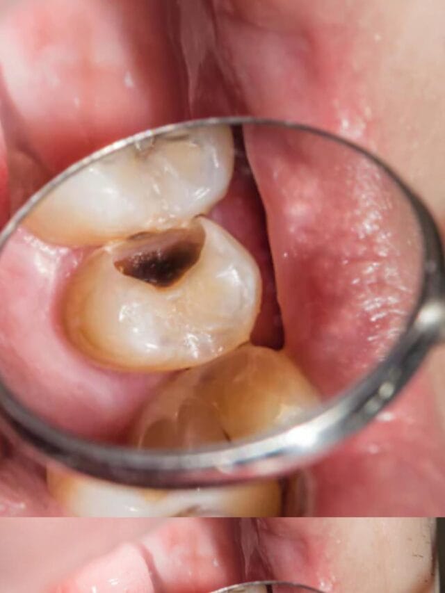 Tooth Cavity
